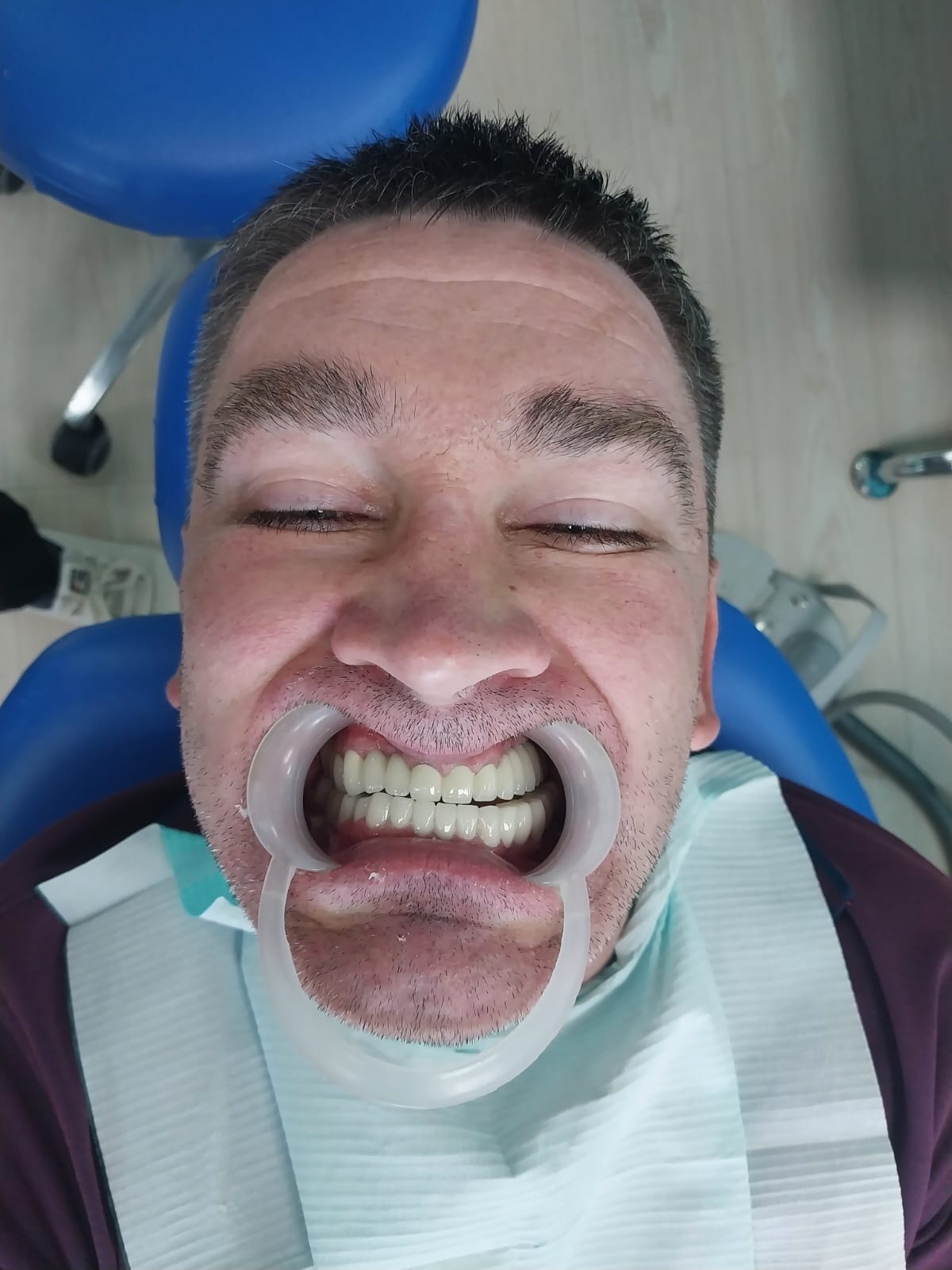 после протезирования зубов в Китае